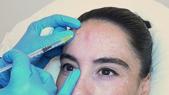 Macarena se realiza el tratamiento eliminar arrugas frente en clinica EB