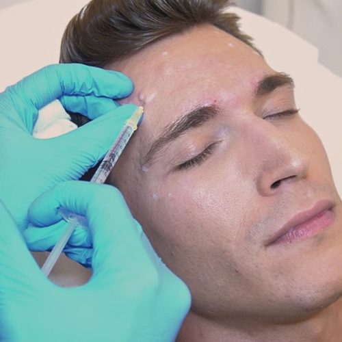 Eliminar arrugas frente con bótox y Hugo Fuertes paciente ClÍnica EB