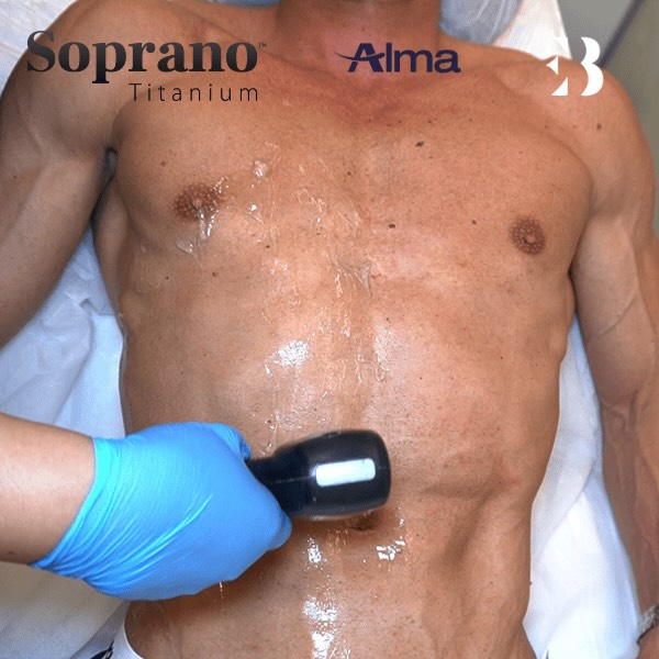 Depilación láser sin dolor en pecho con Antonio Rossi Paciente Clínicas EB