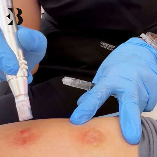 Polinucleótidos Cicatrices en Madrid. Paciente Frigenti de la Clínica EB