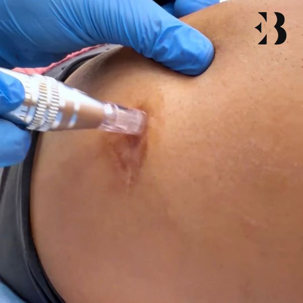 Polinucleótidos Cicatrices y estrias en Madrid. Paciente Frigenti de la Clínica EB