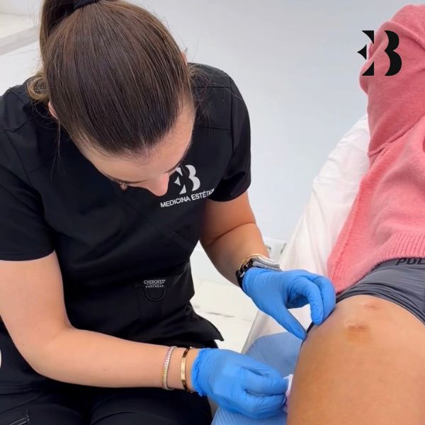 Polinucleotidos tratamiento paciente Frigenti Cicatrices y Estrías