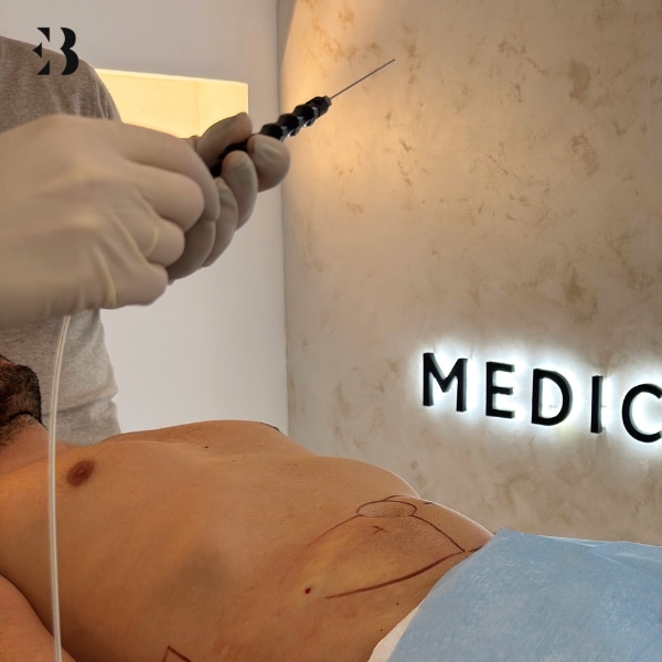 lipolaser abdomen madrid confiable