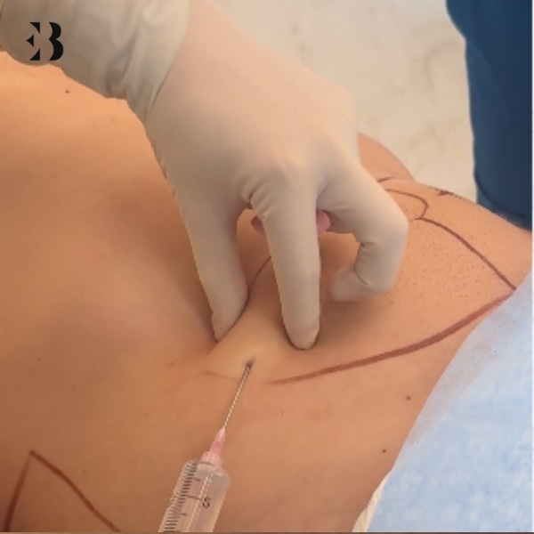 lipolaser abdomen madrid cuanto dura