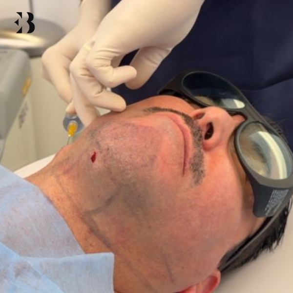 lipolaser papada cuanto cuesta