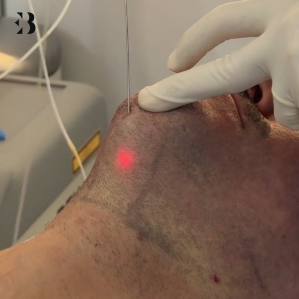 lipolaser papada precio