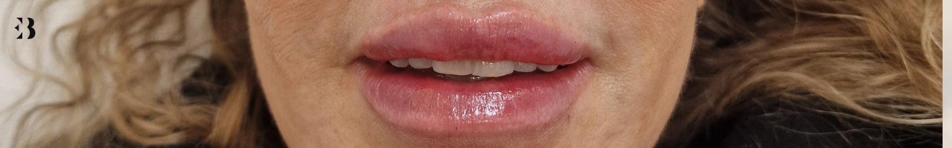 acido hialuronico labios antes y despues