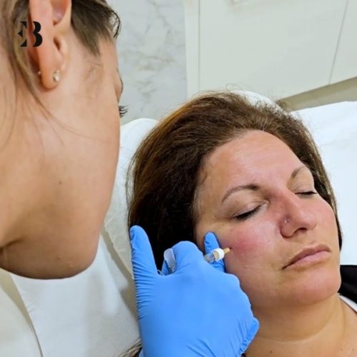 aumento de pomulos con acido hialuronico