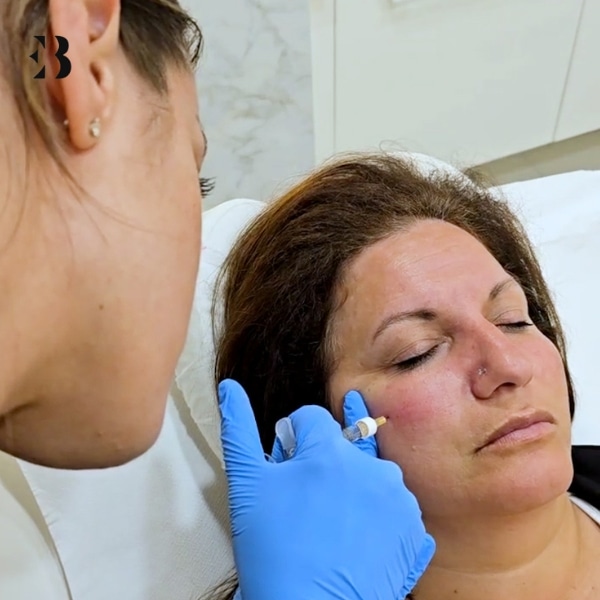 aumento de pomulos con acido hialuronico aumento de pomulos con acido hialuronico