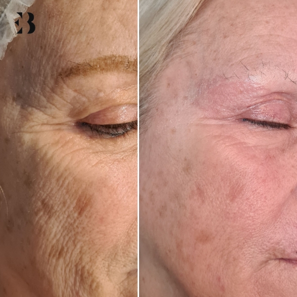 Blefaroplastia sin Cirugía con Láser Plexr. Paciente Clínica EB