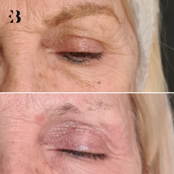 Blefaroplastia sin Cirugía en Madrid. Paciente Clínica EB