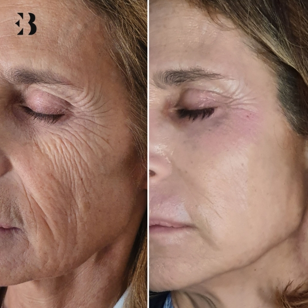 Blefaroplastia sin Cirugía Resultados. Antes y Después Paciente Clínica EB