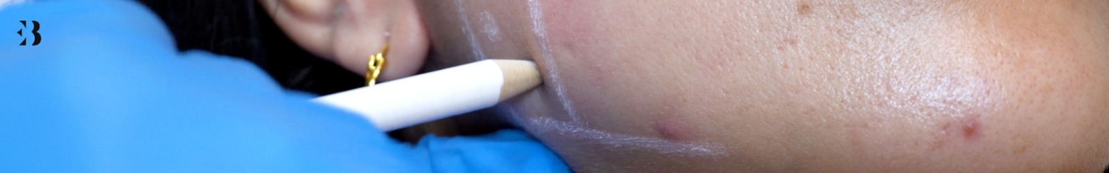 bruxismo consecuencias