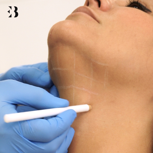 Como quitar la papada sin Cirugía. Tratamientos en Clínicas de Medicina Estética EB