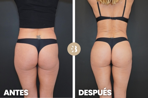 cuantas sesiones de acido hialuronico se necesitan en los gluteos