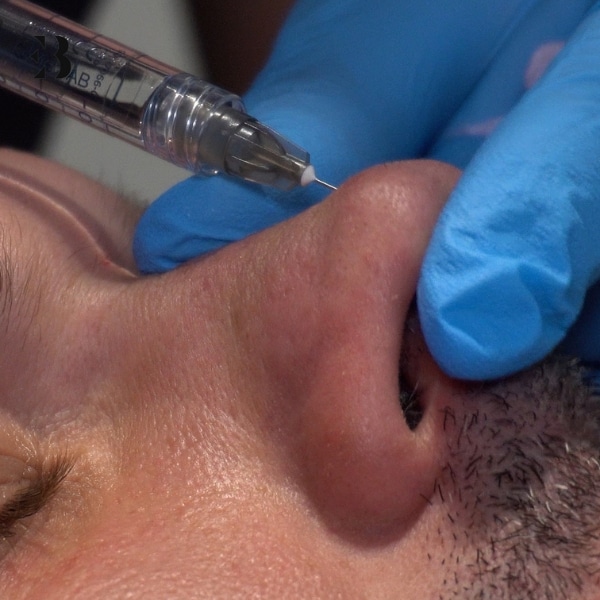 cuanto cuesta una rinomodelacion con acido hialuronico cuanto cuesta una rinomodelacion con acido hialuronico