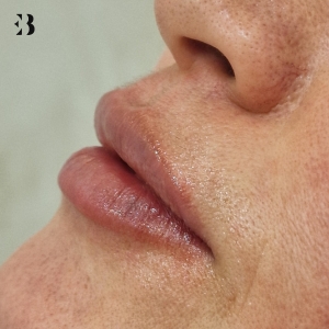 cuanto dura el acido hialuronico en los labios