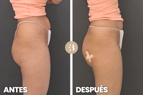 cuanto duran los gluteos con acido hialuronico