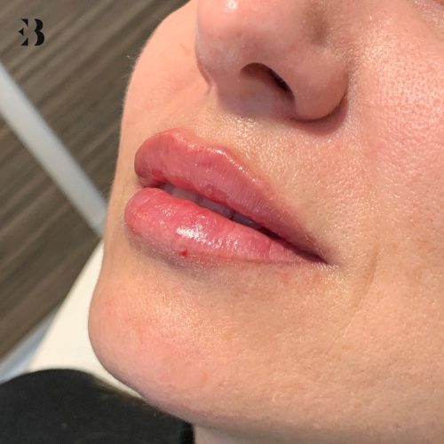 cuanto puede costar un aumento de labios