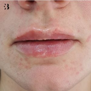 cuanto tiempo dura un perfilado de labios