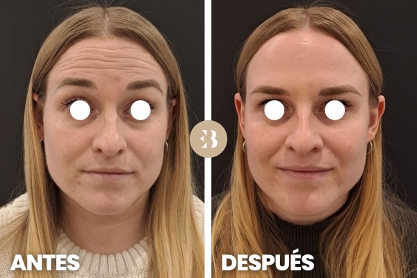 eb antes y despues web antiarrugas eb antes y despues web antiarrugas