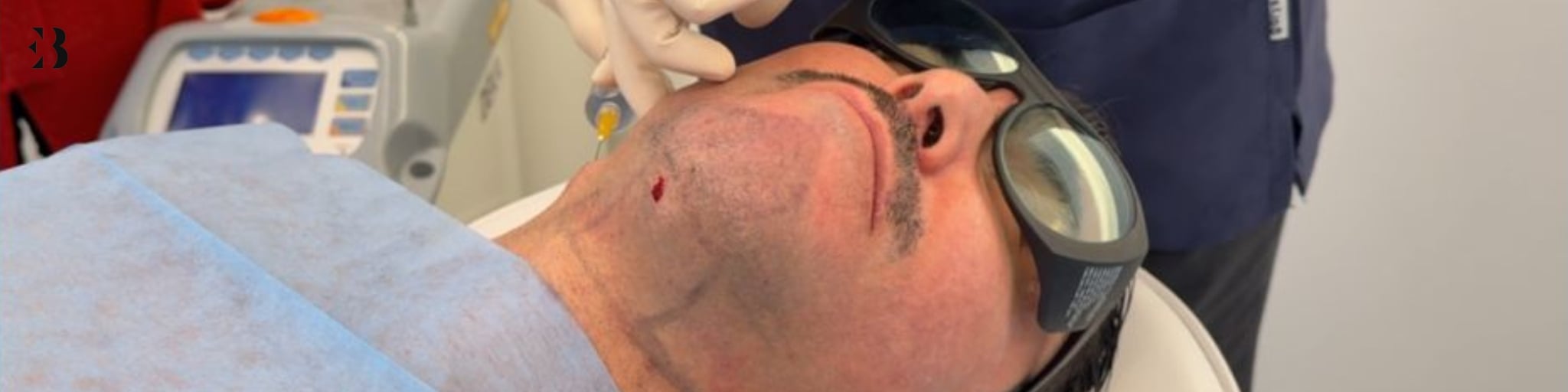 eliminar papada en Madrid