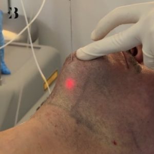 Eliminar Papada sin Cirugía