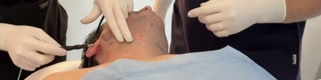 eliminar papada tratamientos médicos estéticos