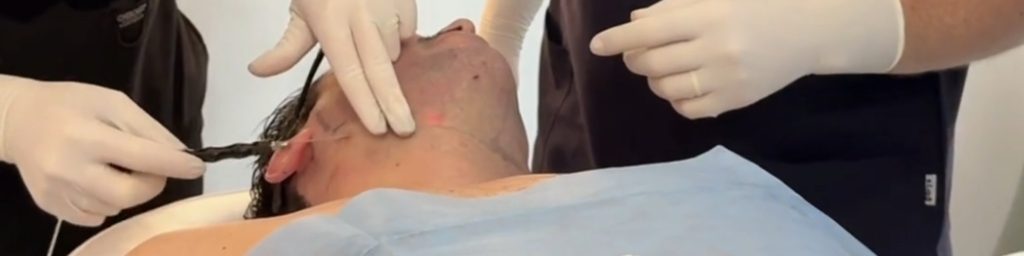 eliminar la papada sin cirugia