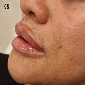 es bueno ponerse acido hialuronico en los labios