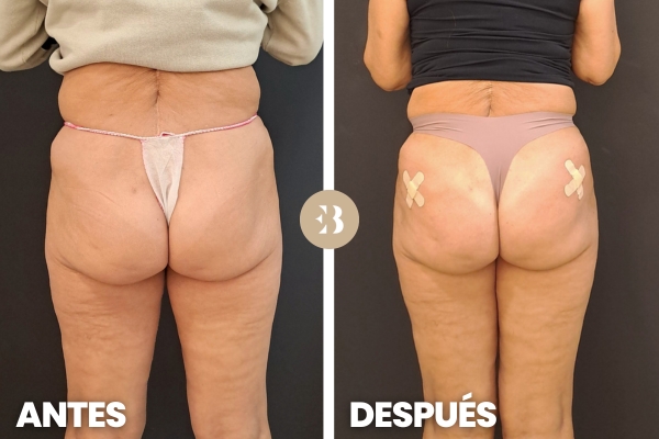 es posible conseguir unos gluteos mas grandes sin cirugia