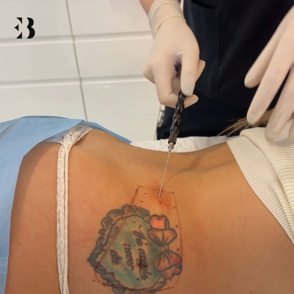 lipolaser precio cuantas sesiones