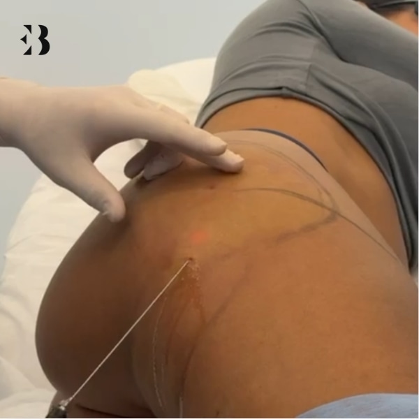 lipolaser precio por zona