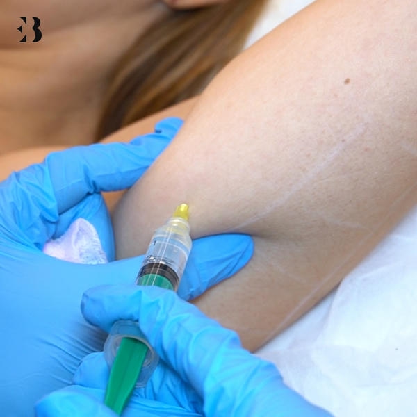 Mesoterapia corporal Tratamiento. Paciente Clínica EB