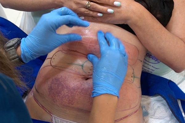 Mesoterapia corporal efectos secundarios. Paciente Clínica EB