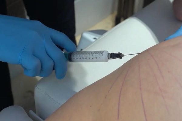 Mesoterapia corporal microinyecciones. Paciente Clínica EB