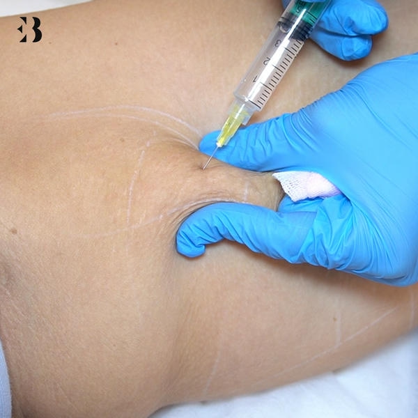 Precio Mesoterapia corporal. Paciente Clínica EB