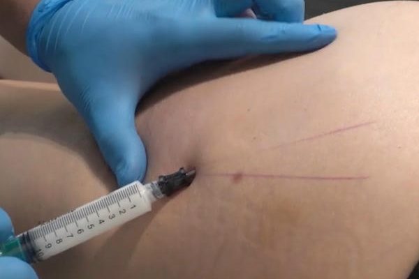 ¿Qué es la mesoterapia corporal?. Paciente Clínica EB