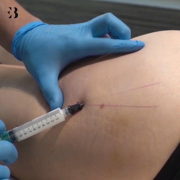 ¿Qué es la mesoterapia corporal?. Paciente Clínica EB