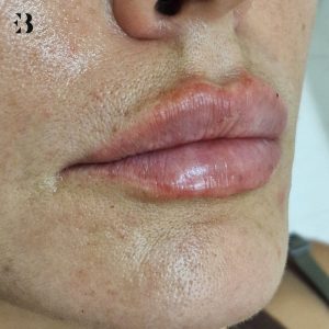 que es la tecnica de labios rusos