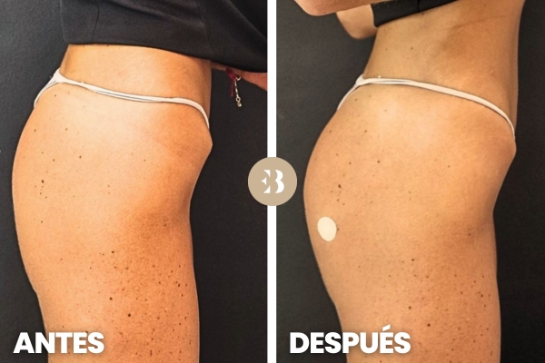 que es mejor para los gluteos peptonas o acido hialuronico