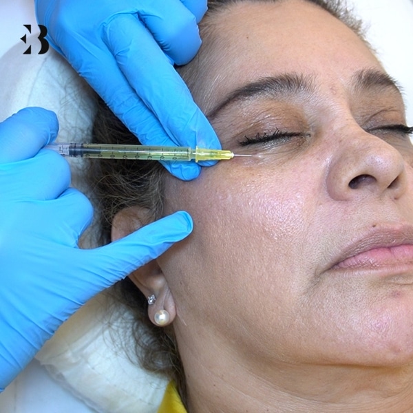 relleno de ojeras con acido hialuronico