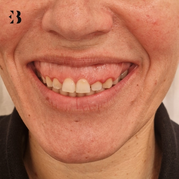 sonrisa gingival precio