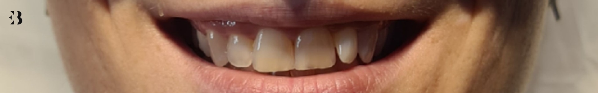 sonrisa gingival que provoca