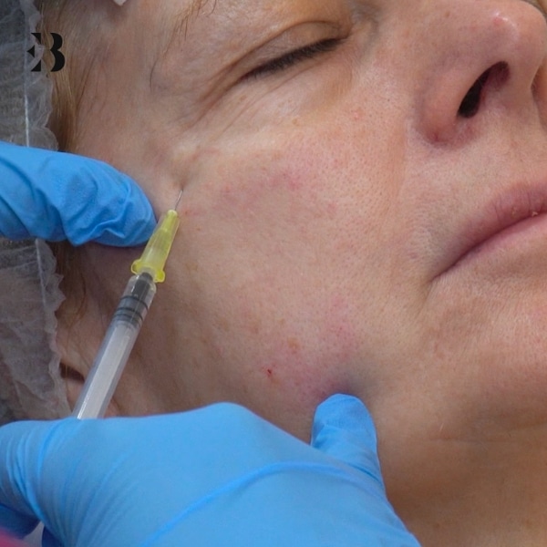 Eliminar arrugas de expresión. Pacientes clínica EB.