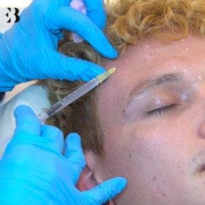 Mejor Tratamiento para eliminar arrugas en la clinica de medicina estetica EB