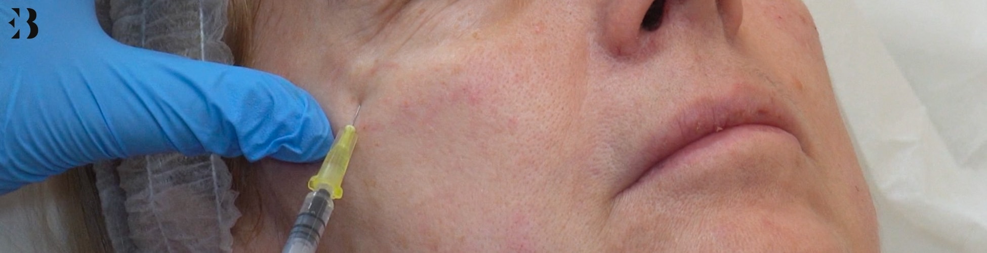 mejor tratamiento eliminar arrugas en la clinica de medicina estetica EB