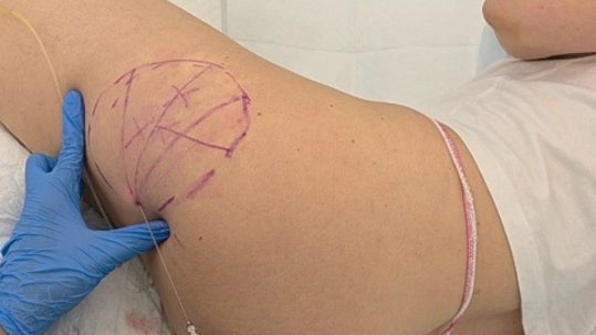 Lipoláser Deka sin cirugía. Paciente clínica Elena Berezo