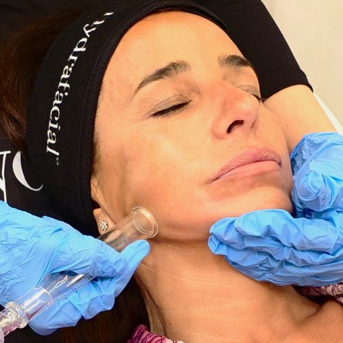 Drenaje linfático hydrafacial. Paciente Carmen Alcayde