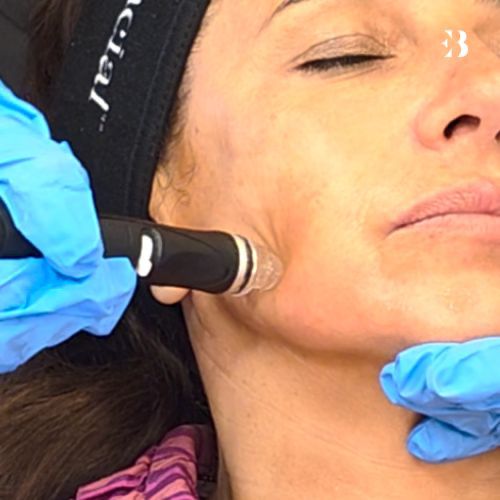 Extracción hydrafacial. Paciente Carmen Alcayde EB